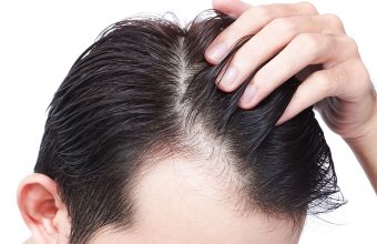 Saç Dökülmesine Ne İyi Gelir?