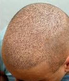 3500 Greft Saç Ekimi Sonuçları