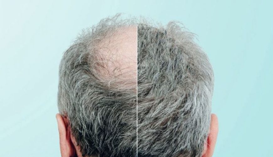 4500 Greft Saç Ekimi Sonuçları