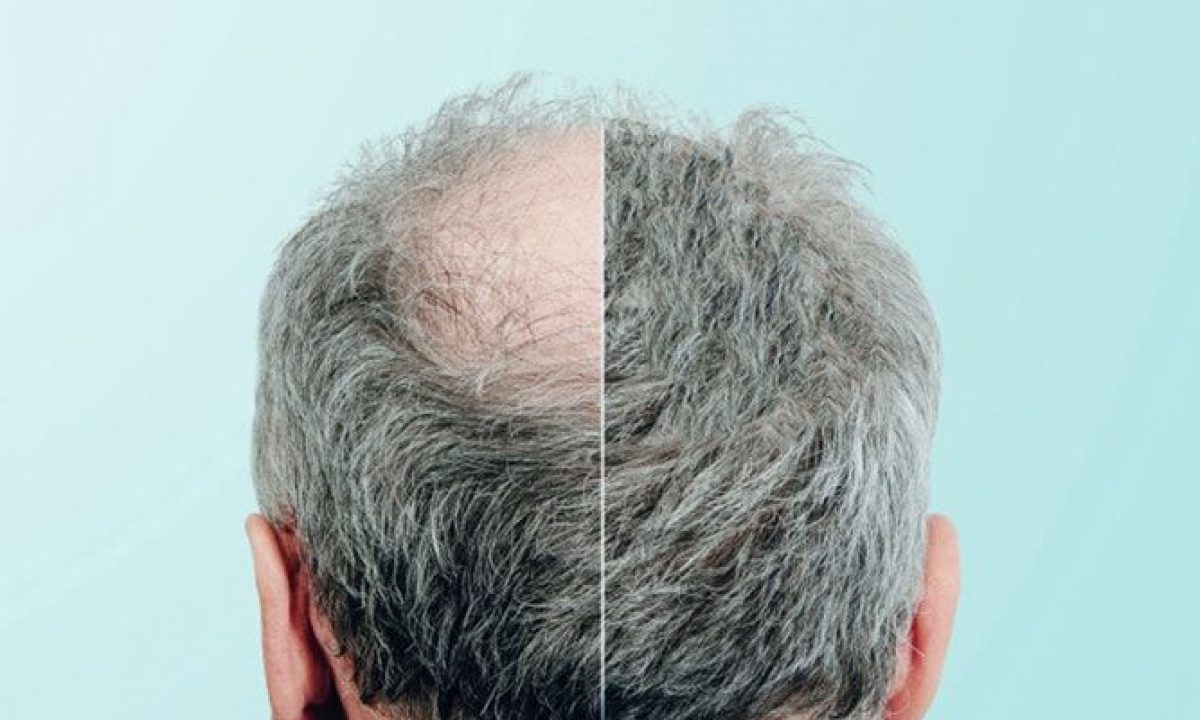 4500 Greft Saç Ekimi Sonuçları