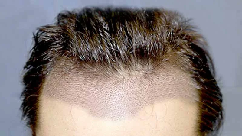 Konya Saç Ekimi Fiyatları