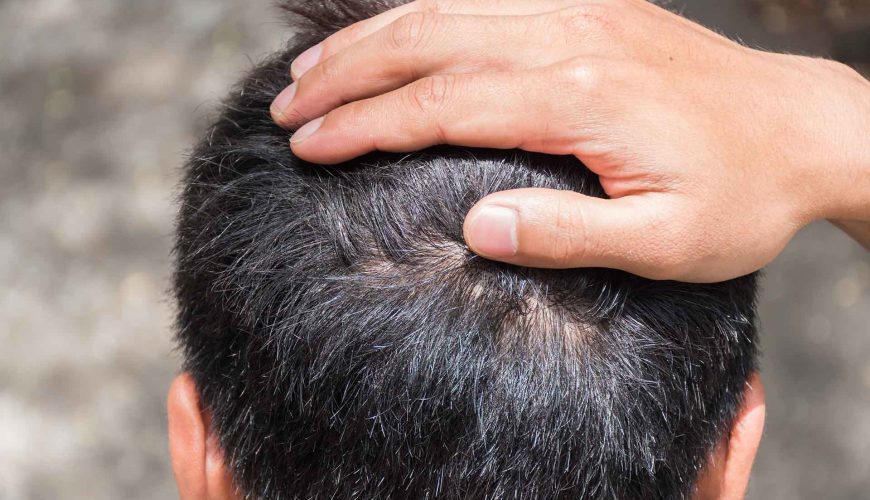 Saç Ekimi Sonrası Sivilce Çıkması