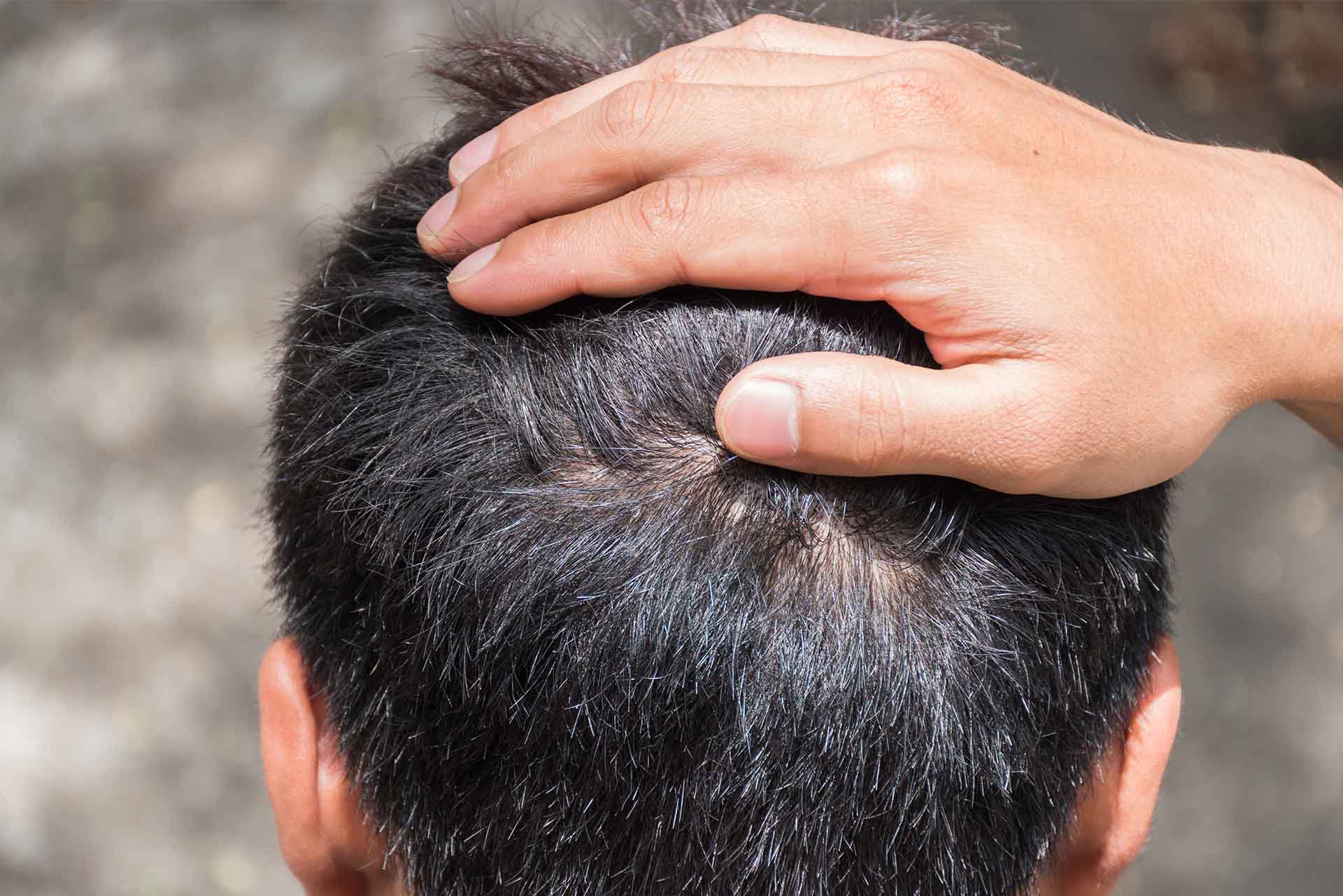 Saç Ekimi Sonrası Sivilce Çıkması