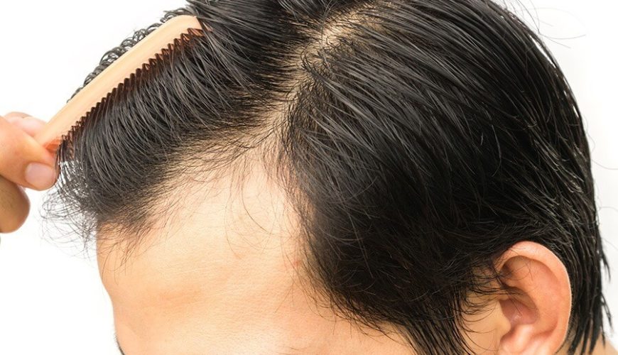 Saç Ekimi Yöntemleri: FUT, FUE ve DHI