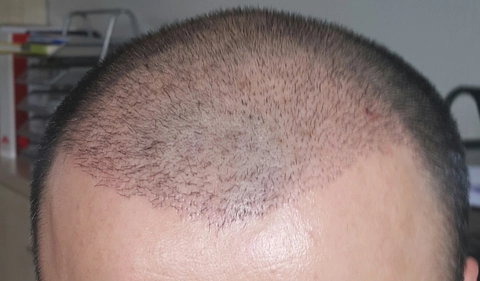 Saç Ekiminde 11. Gün