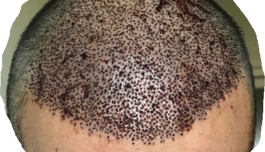 Saç Ekiminde 8. Gün