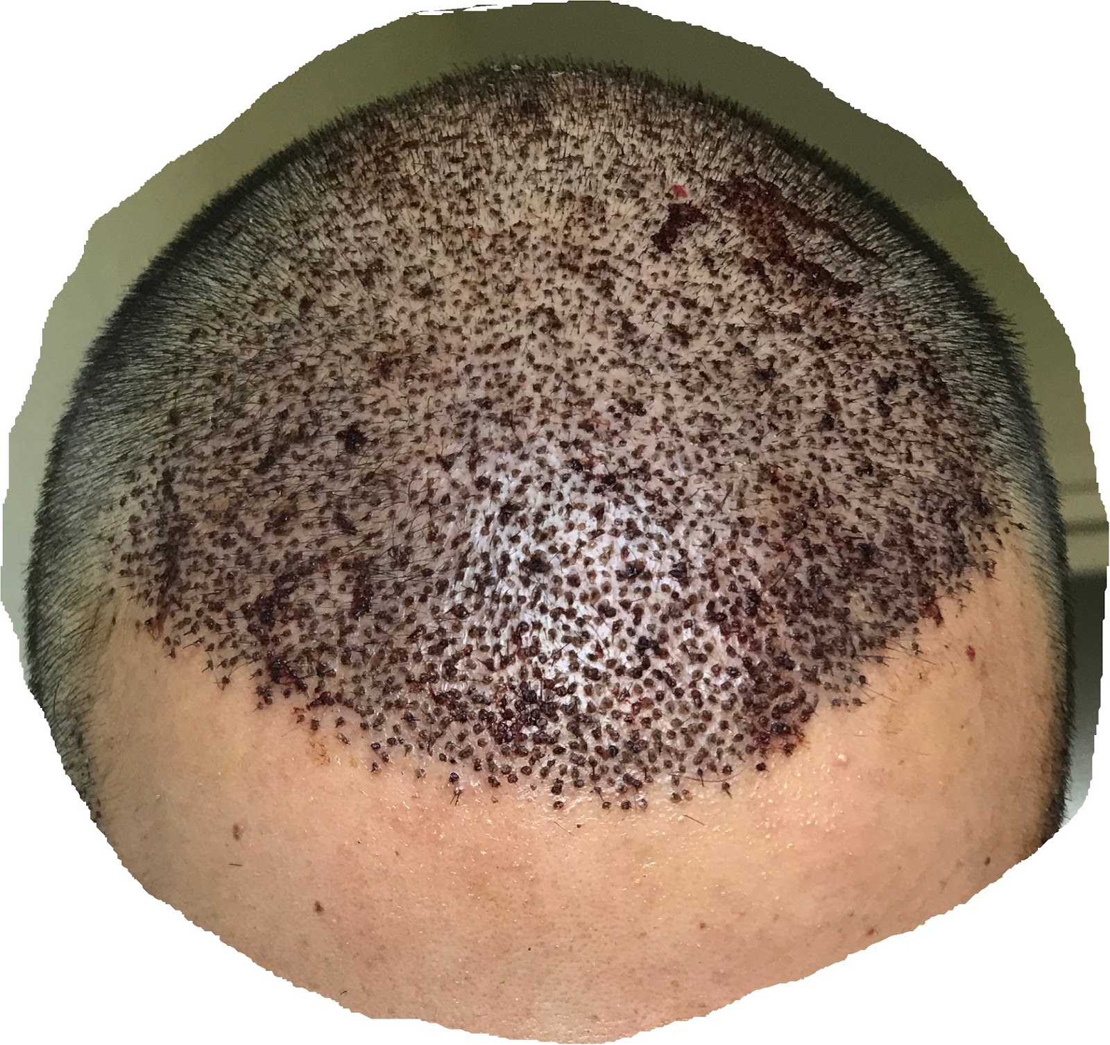 Saç Ekiminde 8. Gün