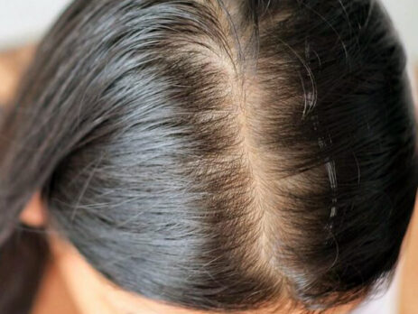 Saç Tepesinde Seyrelme Kadınlarda