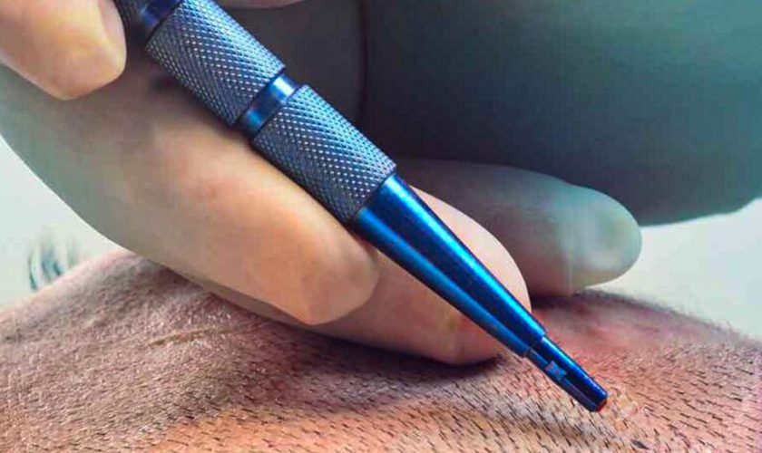 Sapphire FUE Saç Ekimi