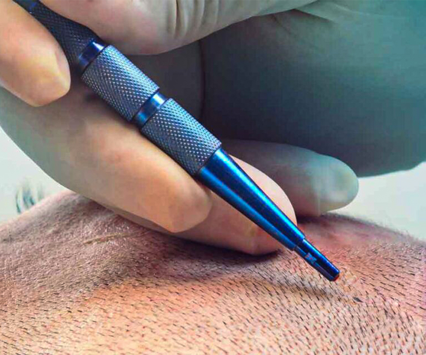 Sapphire FUE Saç Ekimi